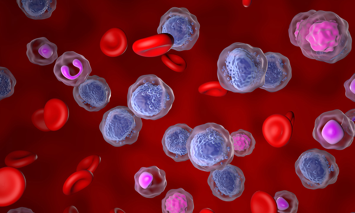 Acute myeloid leukemia (AML) illustration